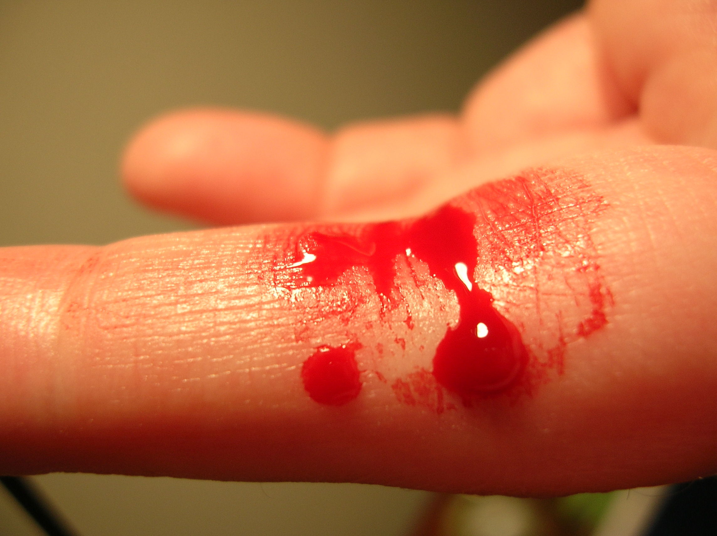 Bleeding Finger